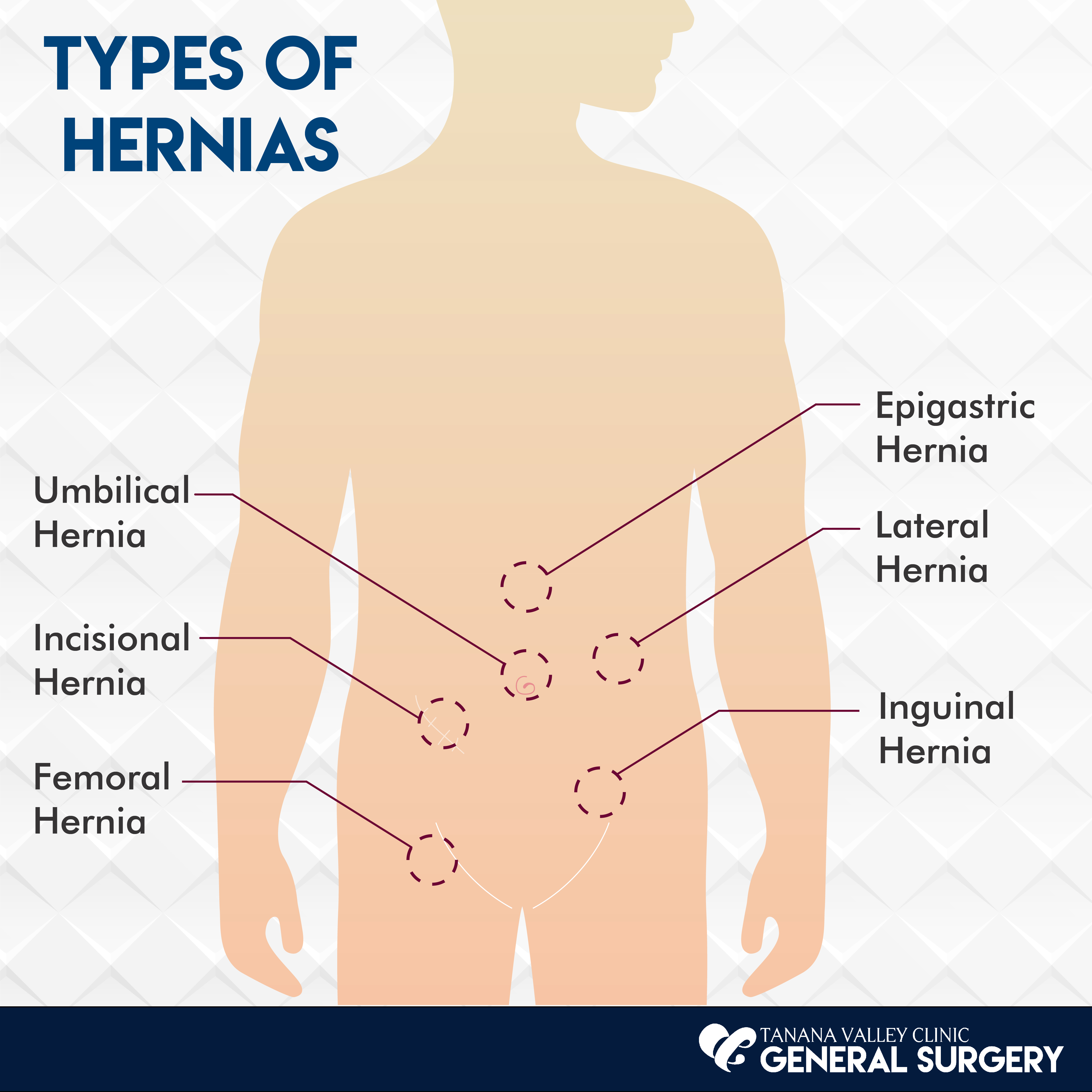 FHP HealthbreAK How to tell the difference between a muscle strain and a hernia