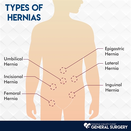 How to Tell If You Have a Hernia