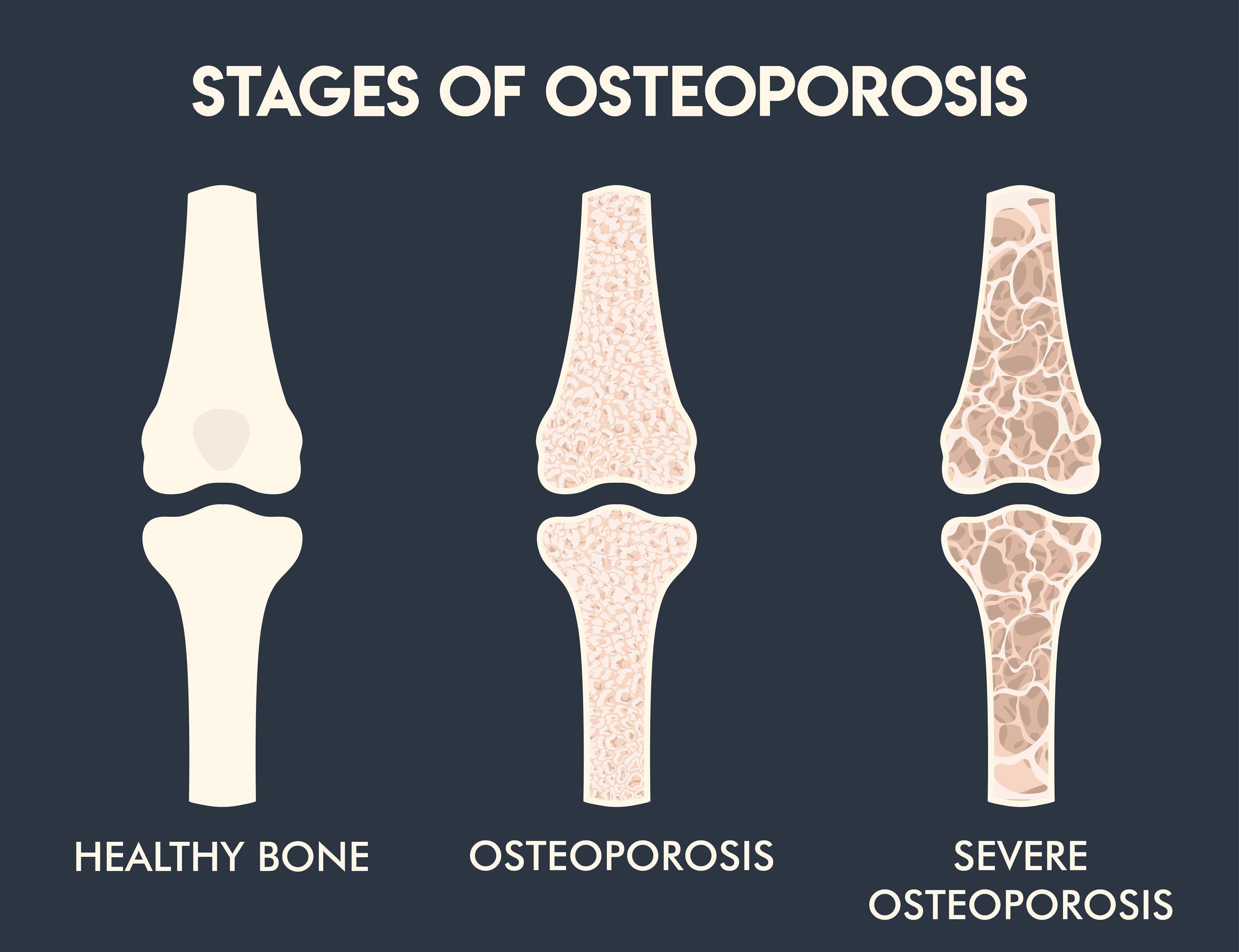 FHP HealthbreAK Osteoporosis and 10 things you can do to prevent it